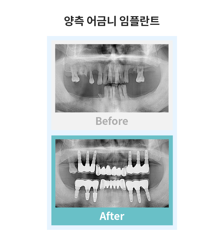 양측어금니임플란트