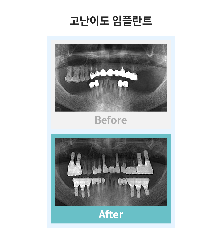 고난이도