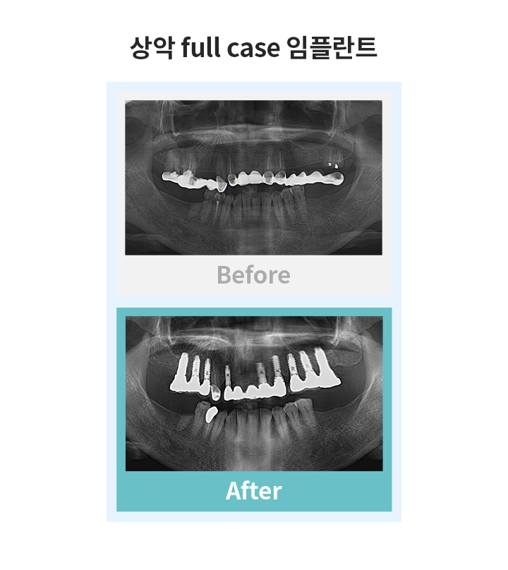 상악 full case 임플란트