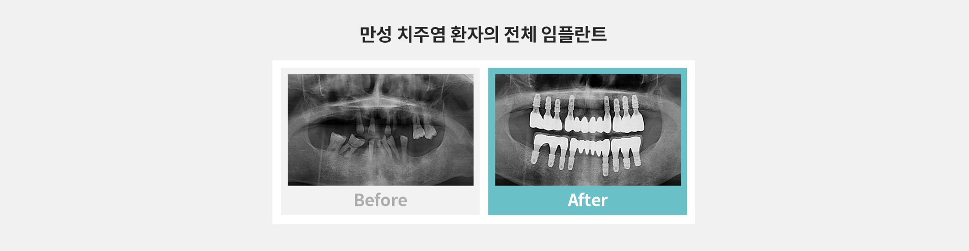 만성치주염임플란트