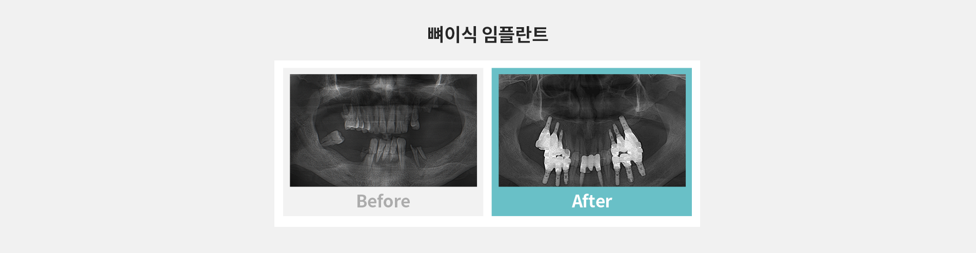 뼈이식 임플란트