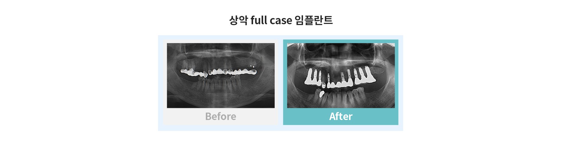 상악 full case 임플란트