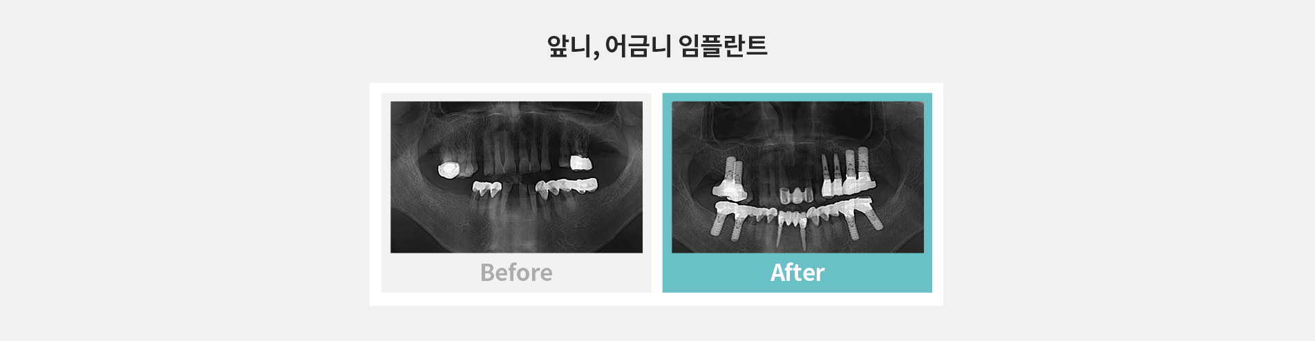 앞니, 어금니 임플란트