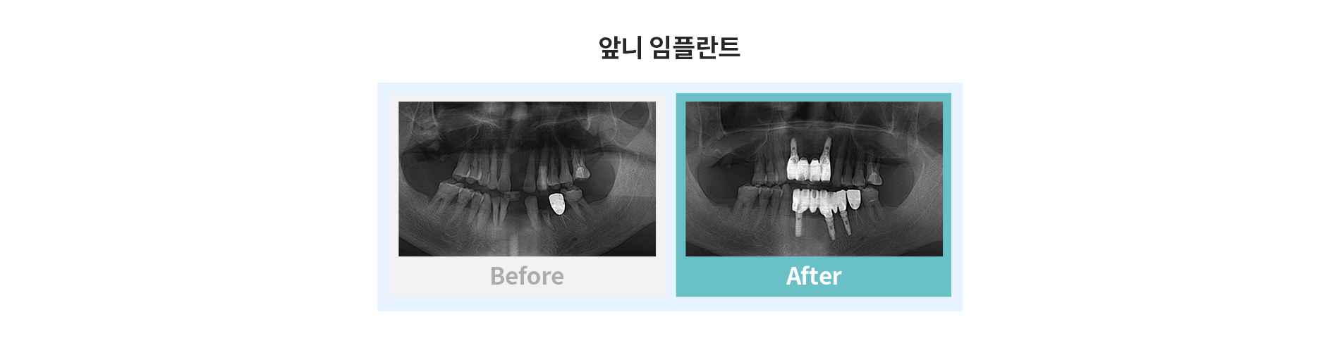 앞니 임플란트