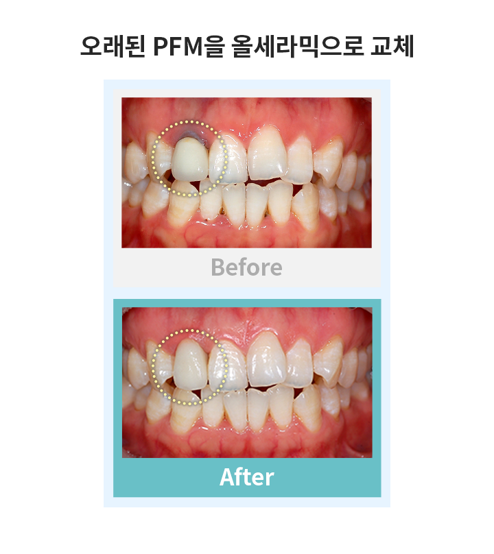 오래된 PMP 울세라믹 교체