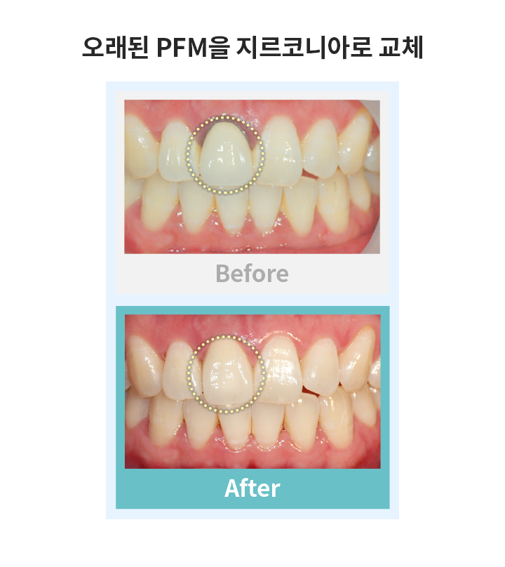 오래된 PFM 지르코니아로 교체