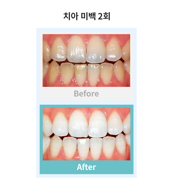 치아미백 2회