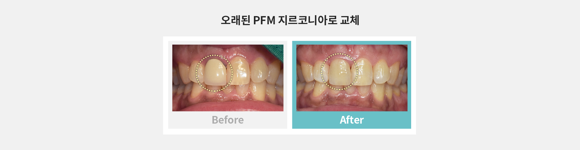 오래된 PFM 지르코니아로 교체