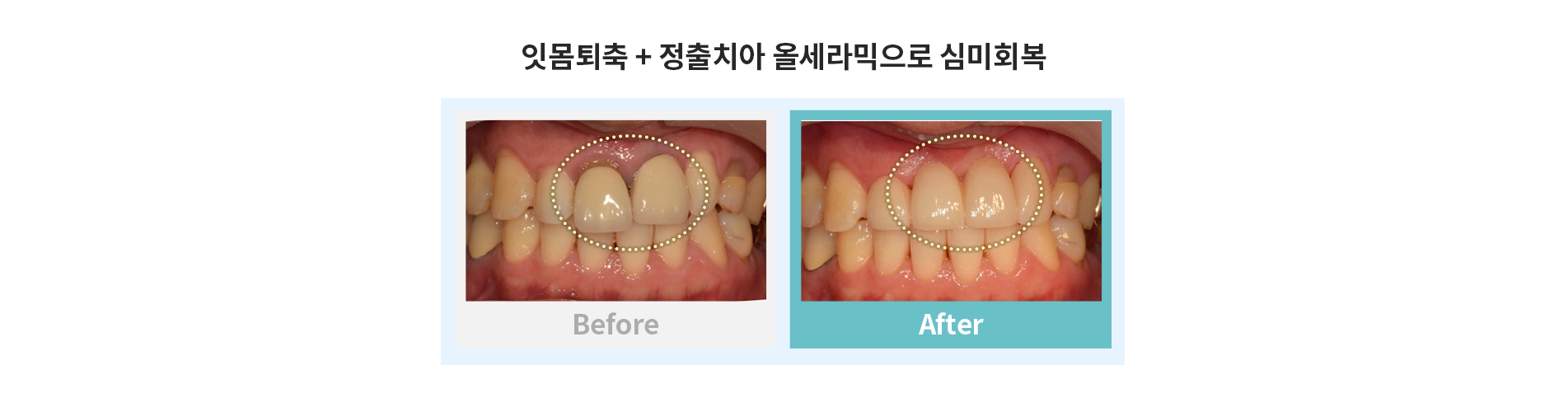 잇몸퇴축+정출치아