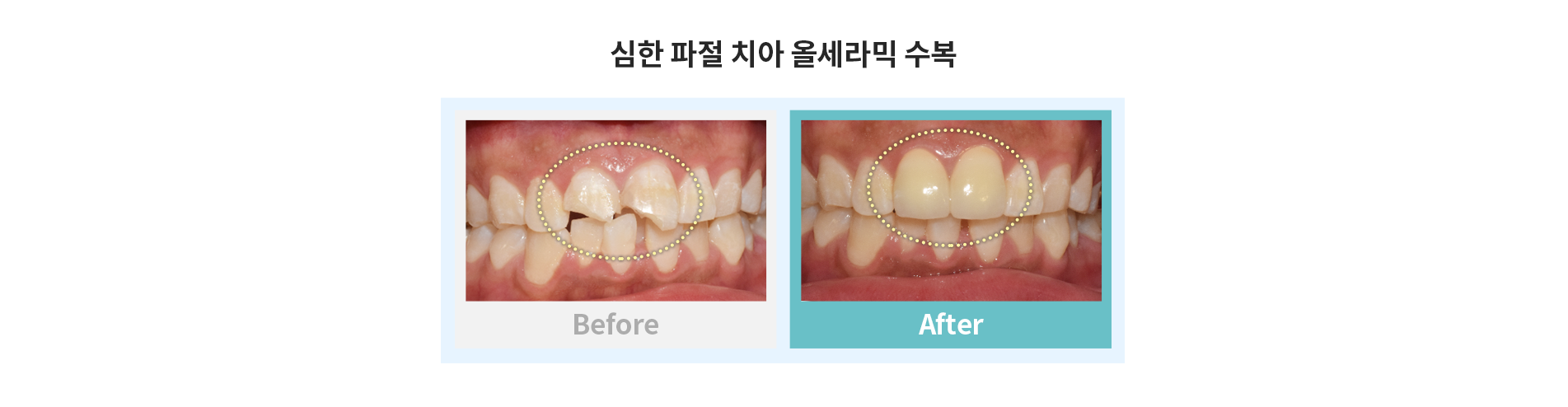 심한 파절 치아 울세라믹 수복