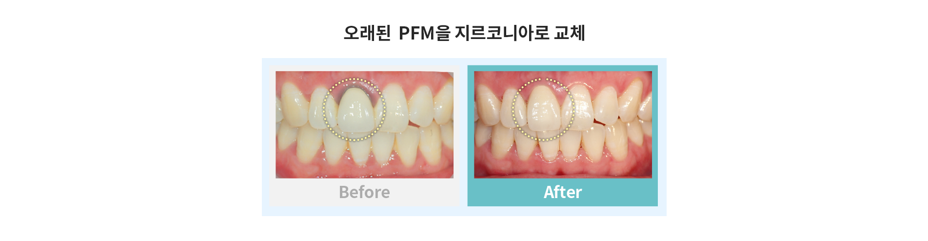 오래된 PFM 지르코니아로 교체