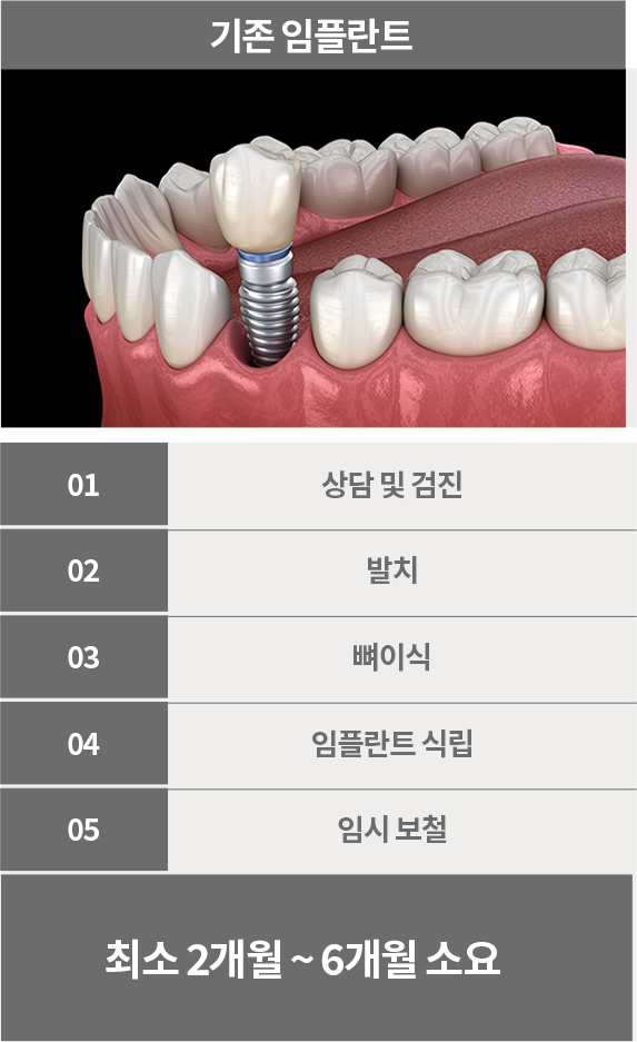 기존 임플란트