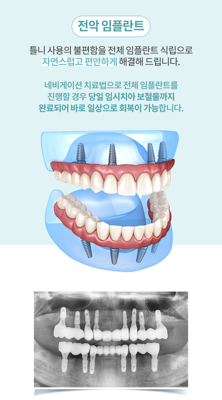 전악 임플란트