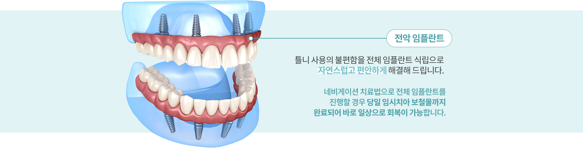 전악 임플란트