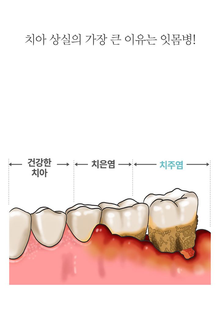 잇몸치료의 핵심은 치아 주위 이물질을 제거하는 것입니다!