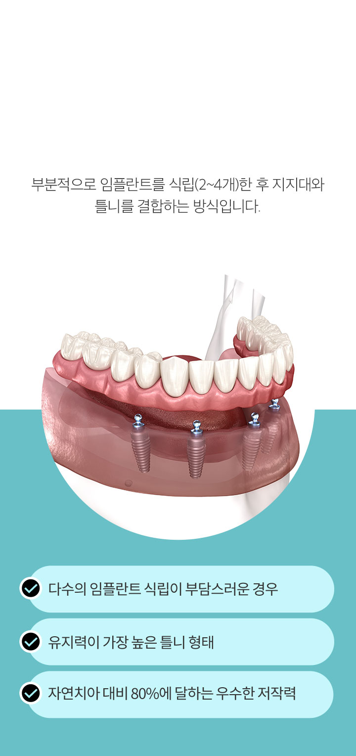 첫 번째, 임플란트 틀니