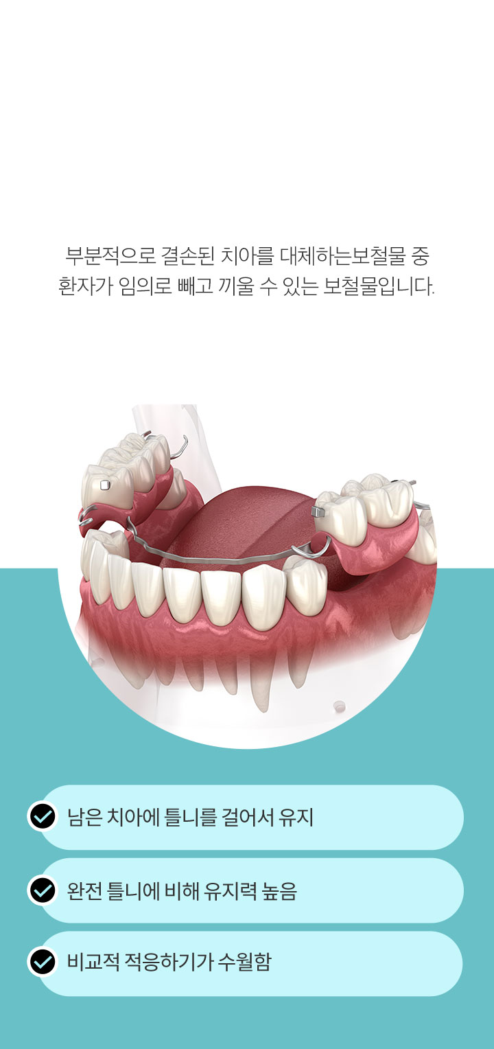 세 번째, 부분 틀니