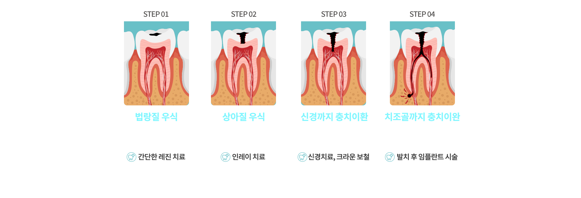 충치 진행단계