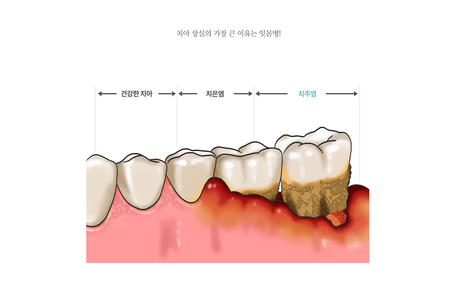 잇몸치료의 핵심은 치아 주위 이물질을 제거하는 것입니다!