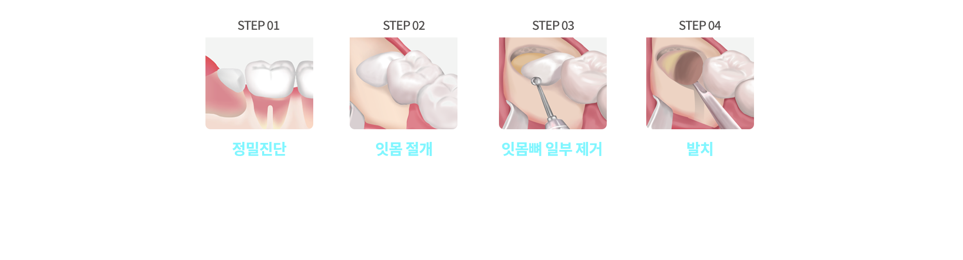 매복 사랑니 발치 과정